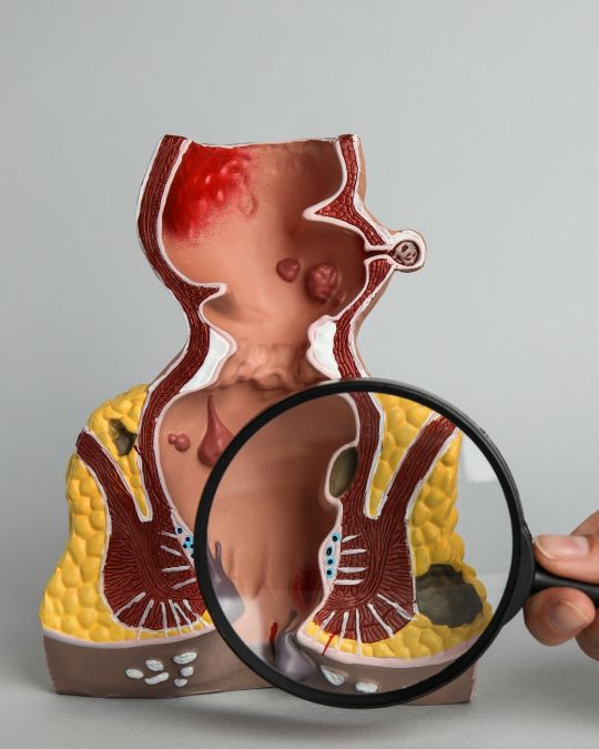 Lupa przykłądana do modelu końcowego odcinka jelita grubego - ilustracja dotycząca rektoskopii w Centrum Medycznym neoMedica w Poznaniu.