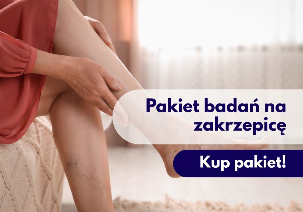 Nogi kobiety z widocznymi żyłami – ilustracja dotycząca pakietu badań na zakrzepicę dostępnego w Centrum Medycznym neoMedica w Poznaniu.