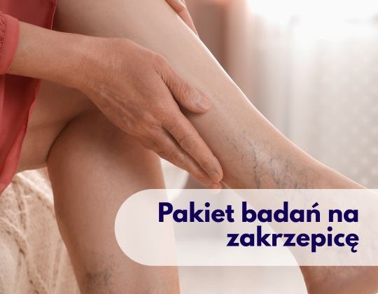 Nogi kobiety z widocznymi żyłami – ilustracja dotycząca pakietu badań na zakrzepicę dostępnego w Centrum Medycznym neoMedica w Poznaniu.